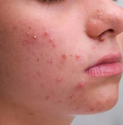 Acne treatment clinic in Coimbatore Acne treatment clinic in Coimbatore