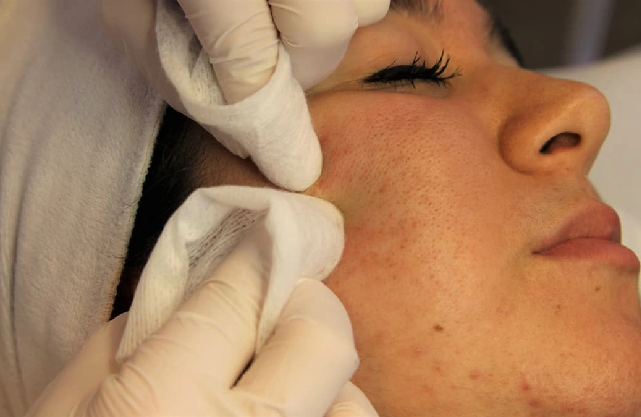 Acne treatment in Coimbatore