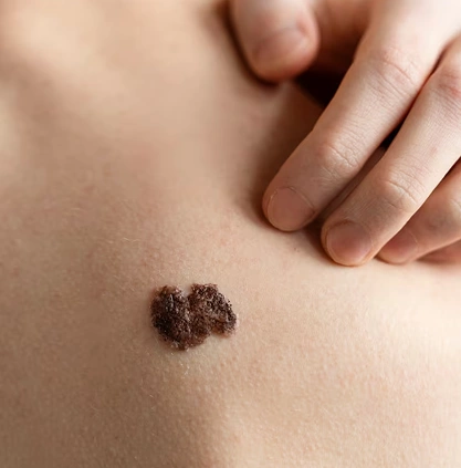 Best wart removal center in Coimbatore Best wart removal center in Coimbatore
